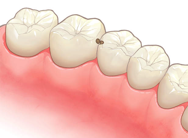 歯と歯茎の境目が黒い原因と歯茎をピンクにする方法 大阪のティコニーデンタルオフィス