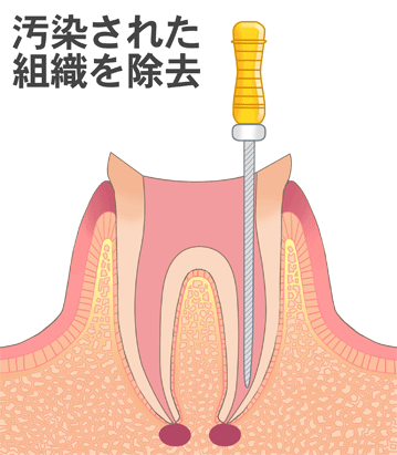 器具で清掃