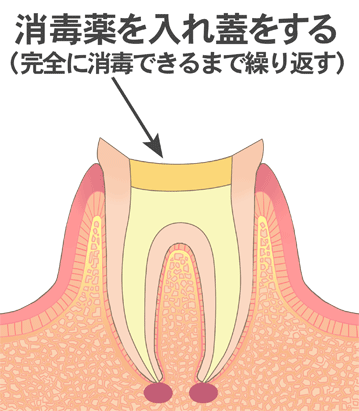 消毒