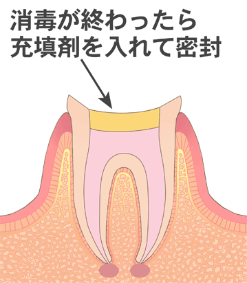 薬剤を詰める