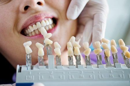 歯の黄ばみを取り除く方法