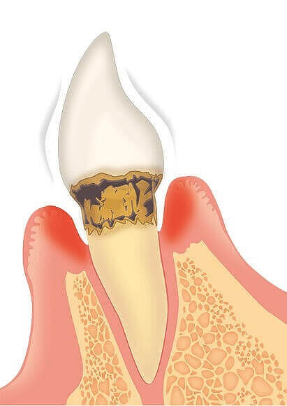 歯周病