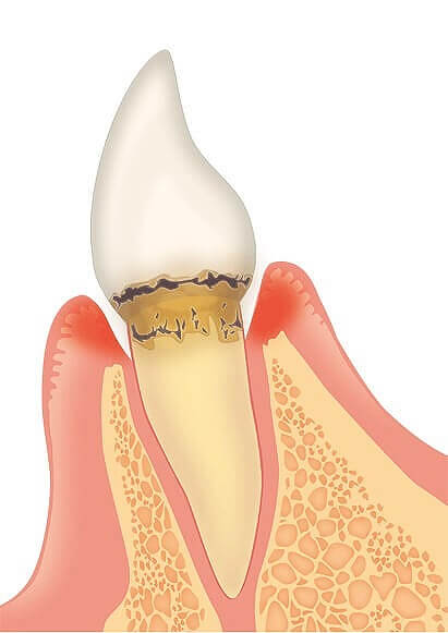 軽度の歯周炎