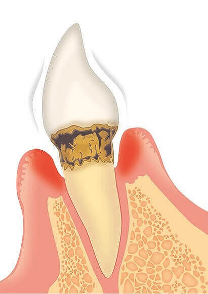 中程度の歯周炎