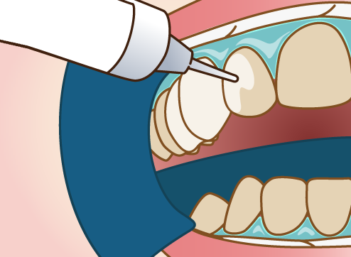 ホワイトニングジェルの塗布
