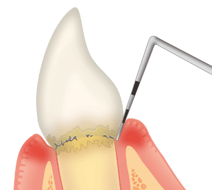 歯周ポケットの検査