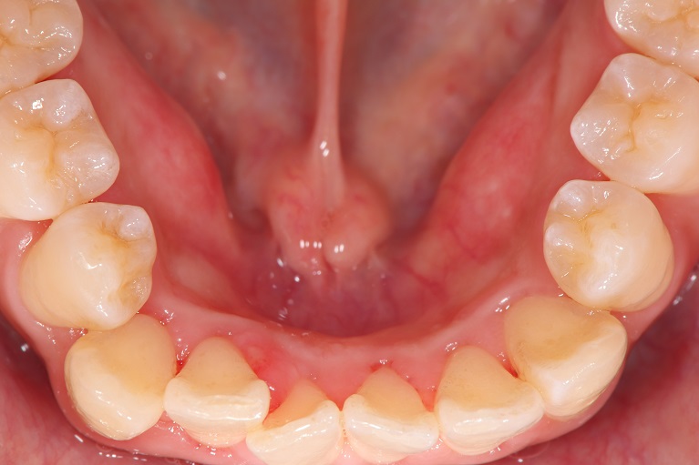 歯石取り（歯石除去）＋歯のクリーニングの症例③after