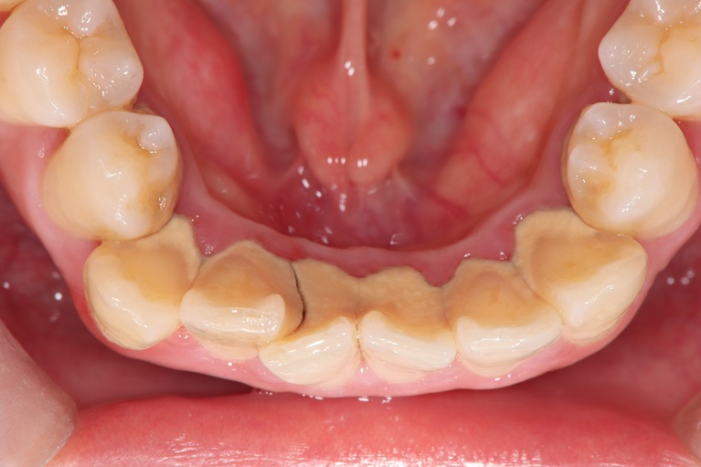 歯石取り（歯石除去）＋歯のクリーニングの症例③before