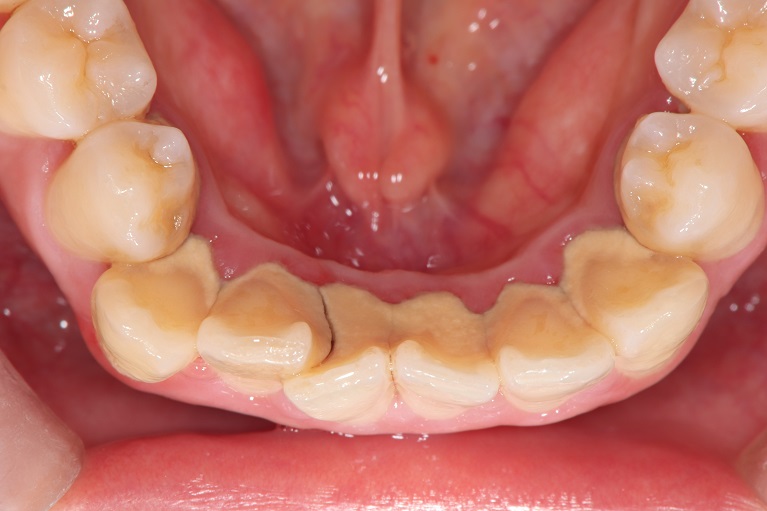 臭い 歯石 歯石が口臭の原因になる3つの理由と臭い解消に効く歯石除去