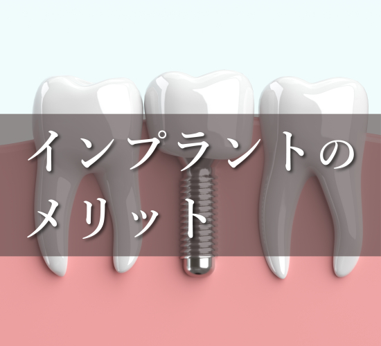 インプラントの魅力をご紹介