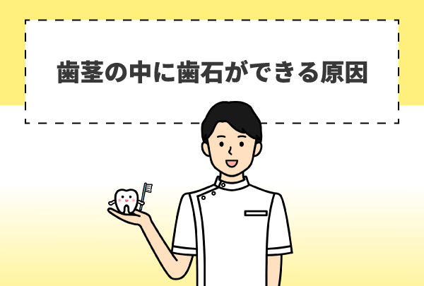 歯茎の中に歯石ができる原因